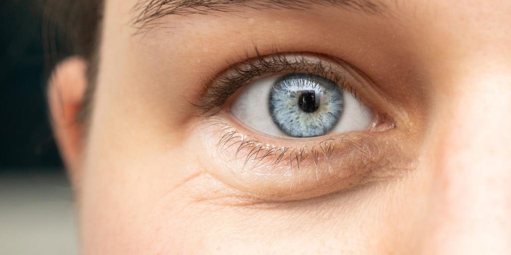 Swollen eyes dark circles red and burning eyes