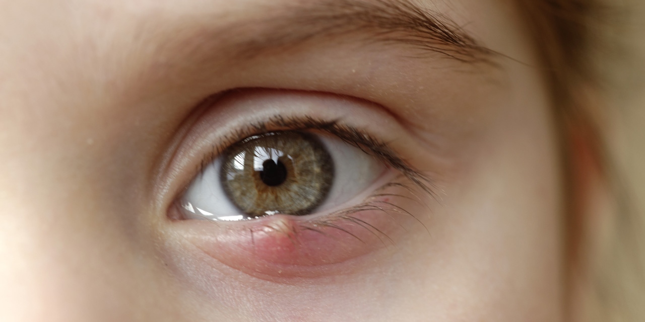 Close-up of a child&apos;s eye stye. Ophthalmic hordeolum disease