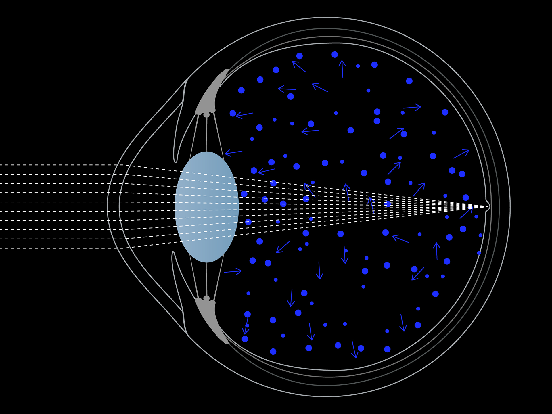 Schematic visualization of blue light scatter in the eye.